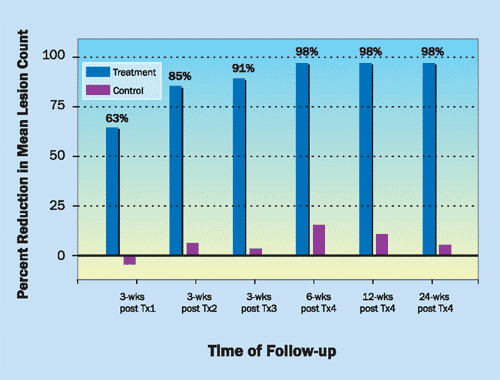Smooth beam laser acne treatment